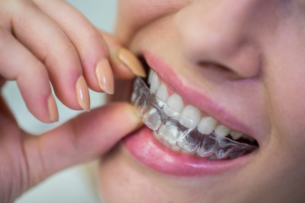 Invisalign braces in JP Nagar